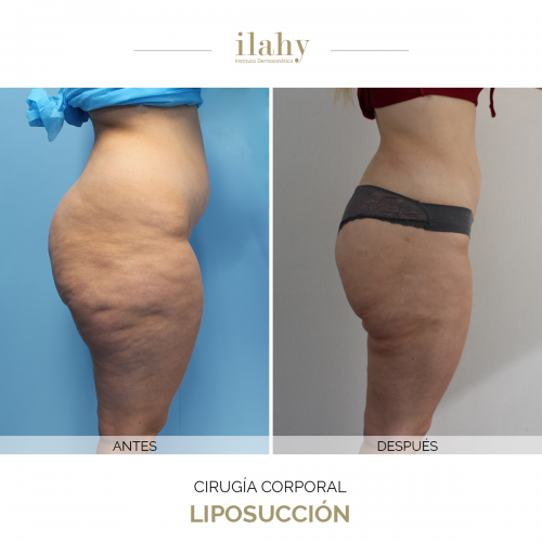 Liposucci�n - Caso de antes y despu�s